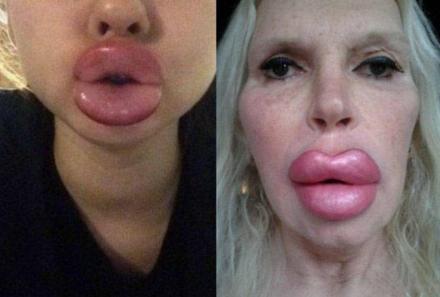 The Real Fat Lips!