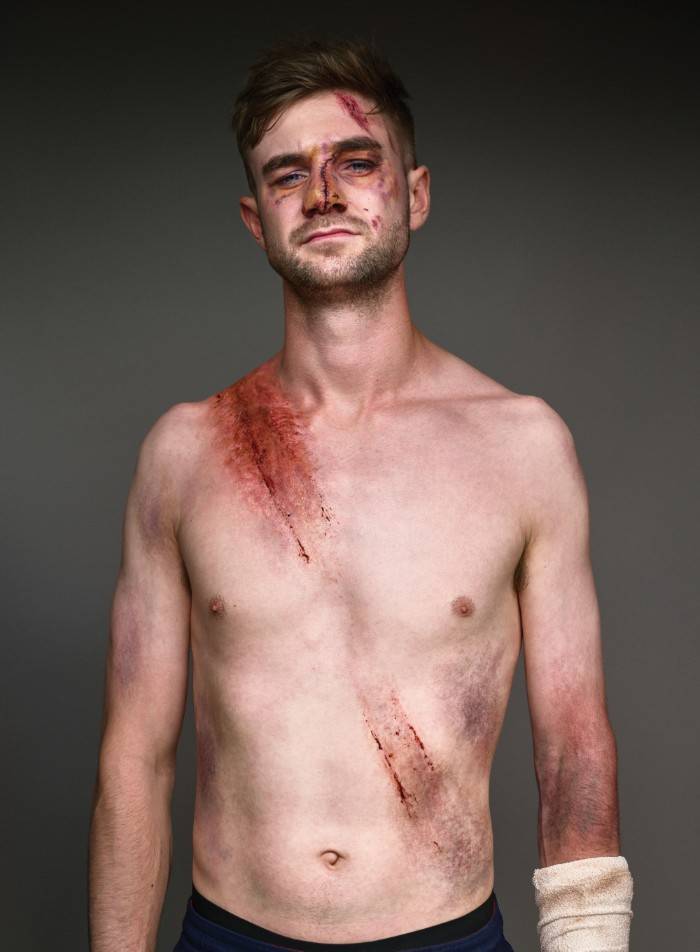 Car Crash Survivors Show The Importance Of Wearing A Seatbelt In A Powerful Social Campaign