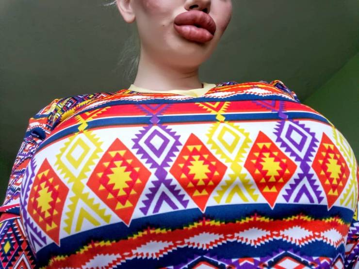 Woman Has Tripled The Size Of Her Lips And Plans On More