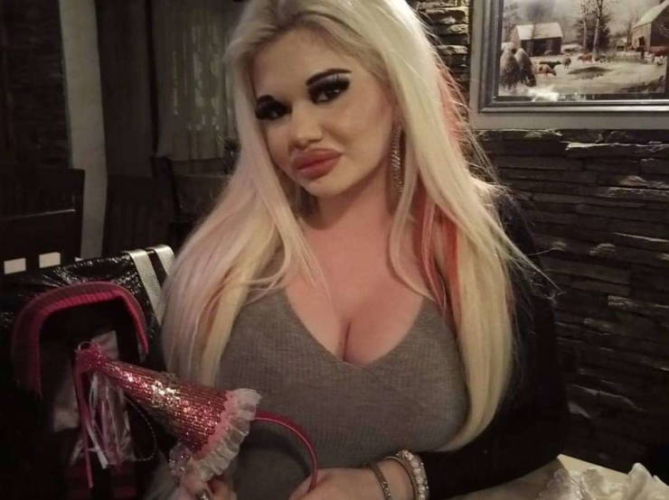 Bulgarian Girl With World’s Largest Lips Enlarged Them For The 20th Time
