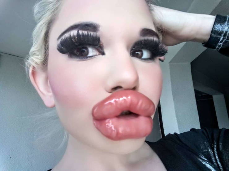 Bulgarian Girl With World’s Largest Lips Enlarged Them For The 20th Time