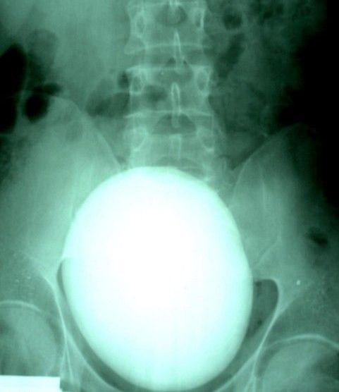 Kidney stone (3 pics)
