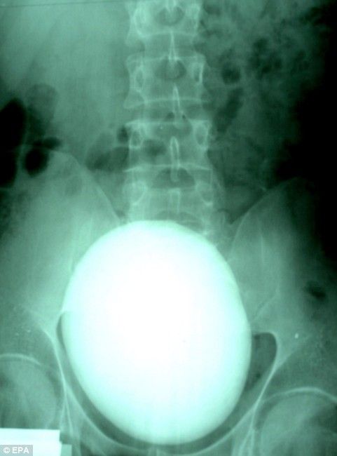 Kidney stone (3 pics)