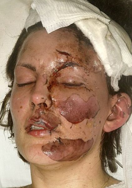 Incredible Healing after a Bomb Explosion (15 pics)