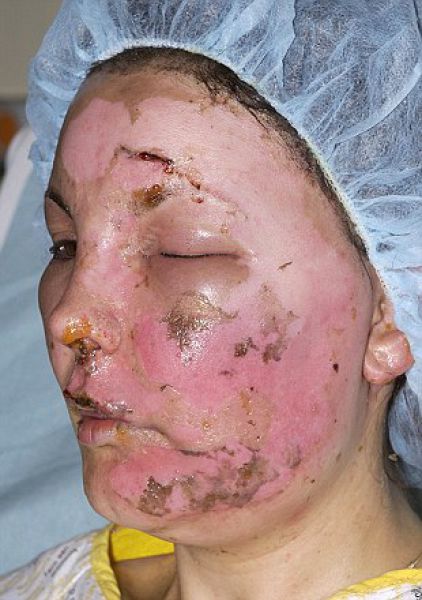 Incredible Healing after a Bomb Explosion (15 pics)