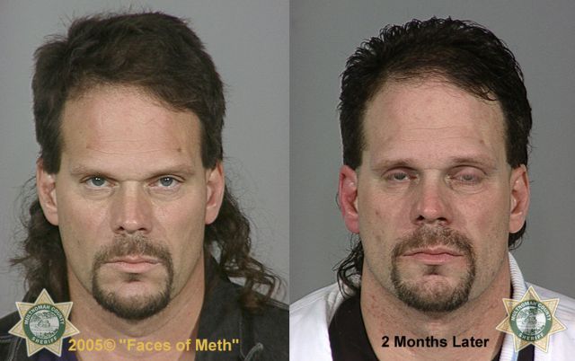 Meth Addicts: Before and After