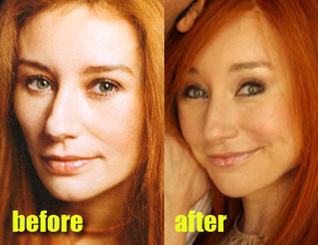 Celebrity Plastic Surgery Before & After.