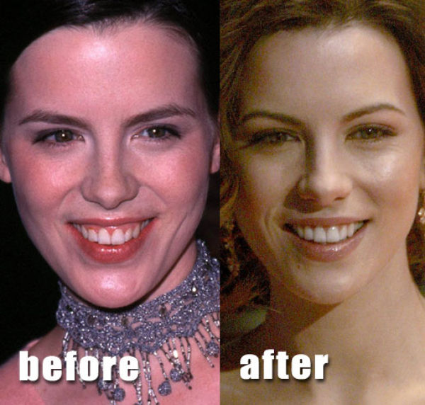 Celebrity Plastic Surgery Before & After
