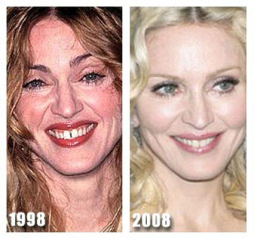 Celebrity Plastic Surgery Before & After