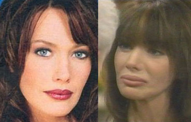 Celebrity Plastic Surgery Before After Pics Izispicy Com
