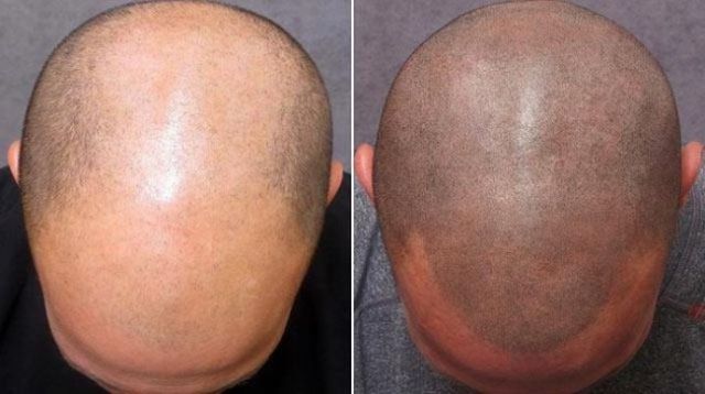 The ‘No Hair’ Solution!