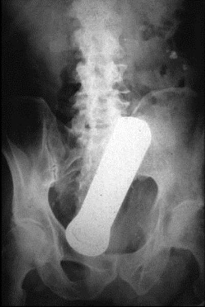 X-Rays That Prove That Horny Guys Are Idiots
