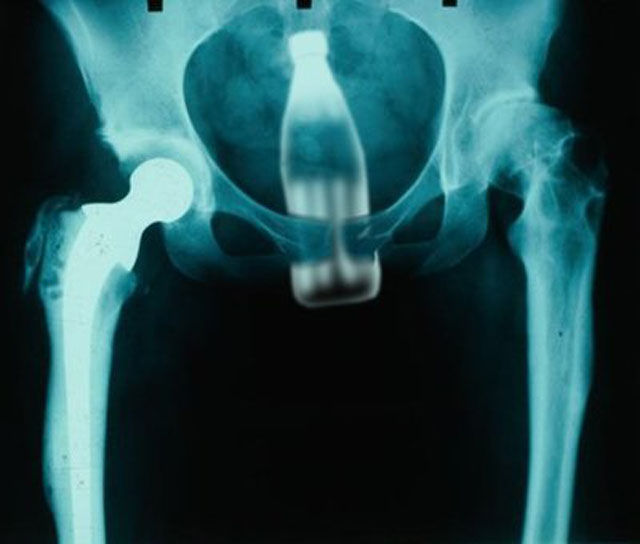 X-Rays That Prove That Horny Guys Are Idiots