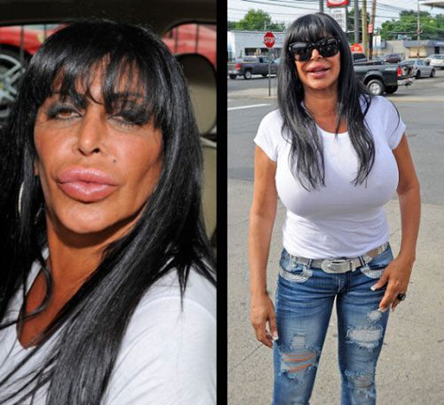 Plastic Surgery Fails That Are Just Wrong
