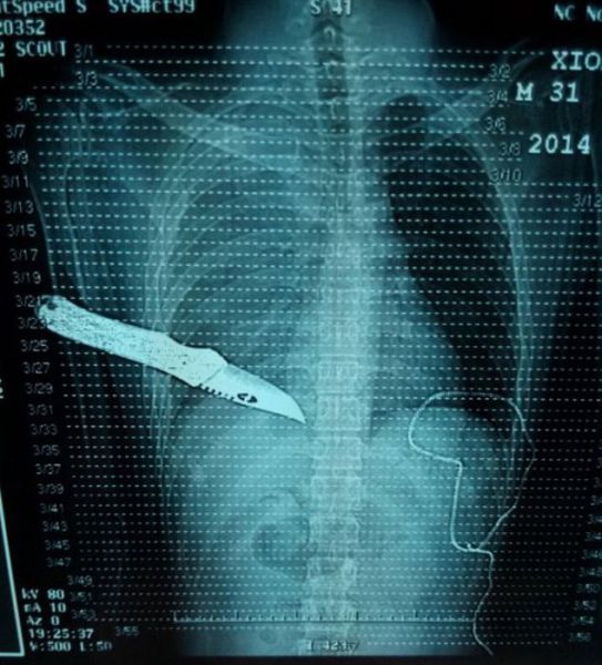Real X-Rays That Are Will Shock You