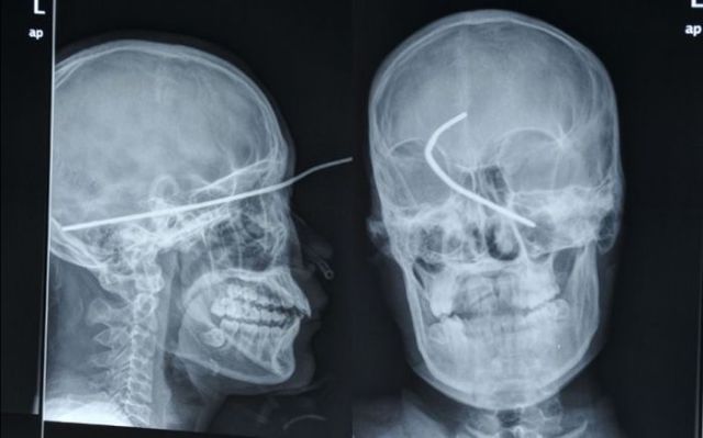 Real X-Rays That Are Will Shock You