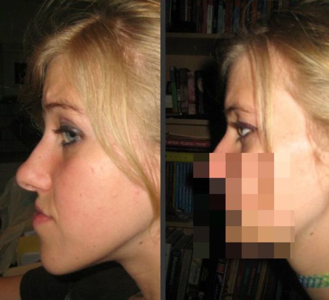 An Incredible Jaw Surgery That Gave This Girl a New Lease on Life