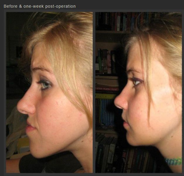 An Incredible Jaw Surgery That Gave This Girl a New Lease on Life
