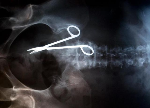 The Most Bizarre Items That Have Gotten Stuck in People’s Bodies