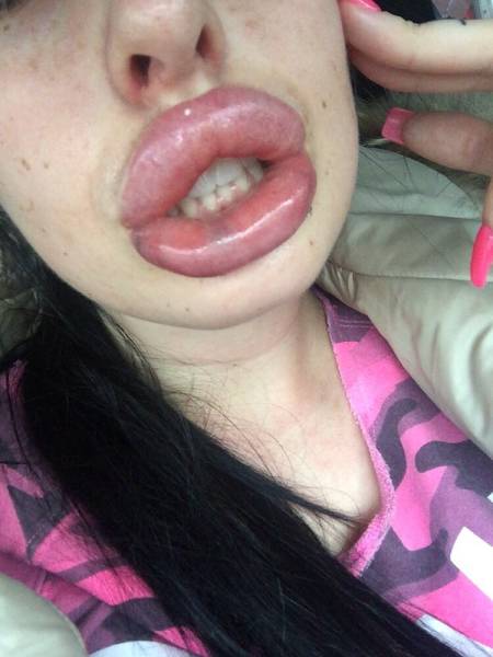 Victim Of The Silicone Injections
