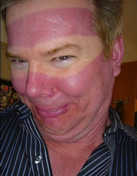 Examples When People Forgot They Can Actually Get Sunburns If They Don