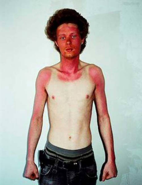 Examples When People Forgot They Can Actually Get Sunburns If They Don