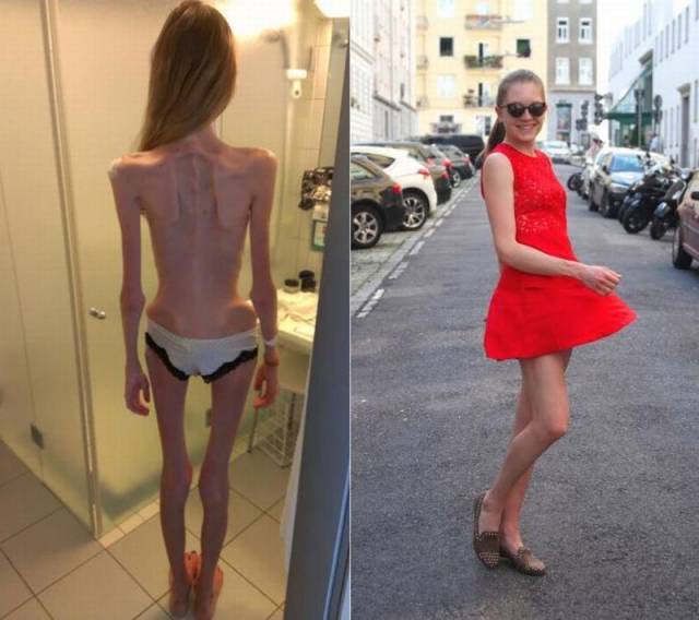 Anorexic Girl Was Only Several Days Away From Death But Managed To Recover