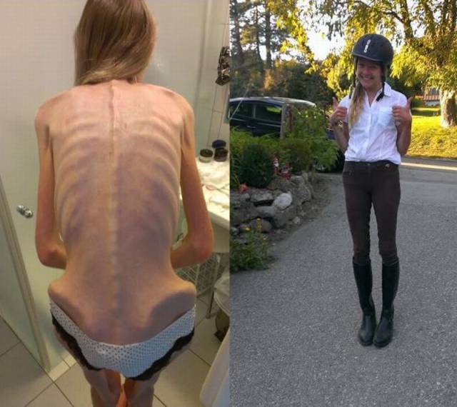 Anorexic Girl Was Only Several Days Away From Death But Managed To Recover